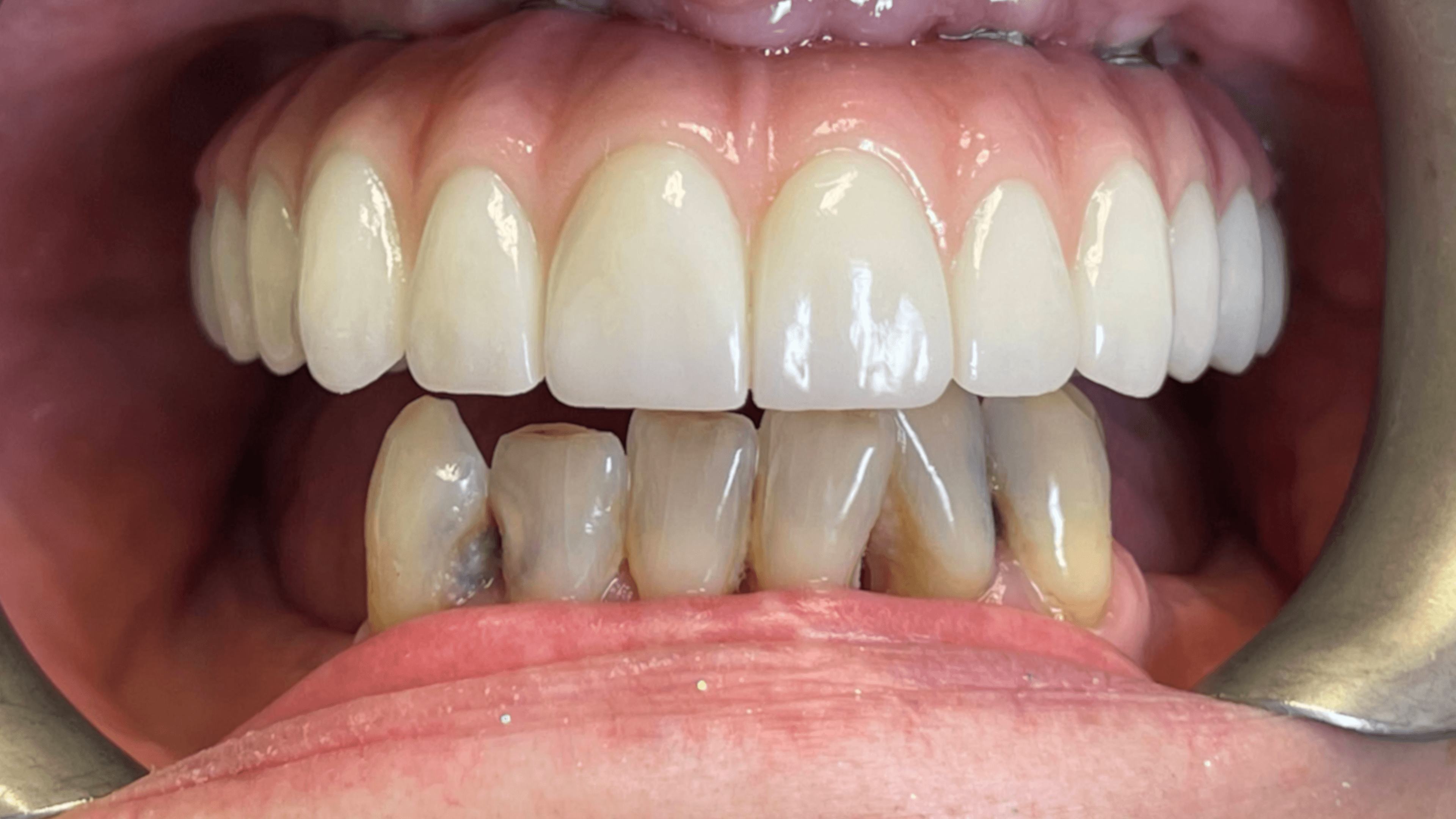 Patient after full arch restoration showing new smile