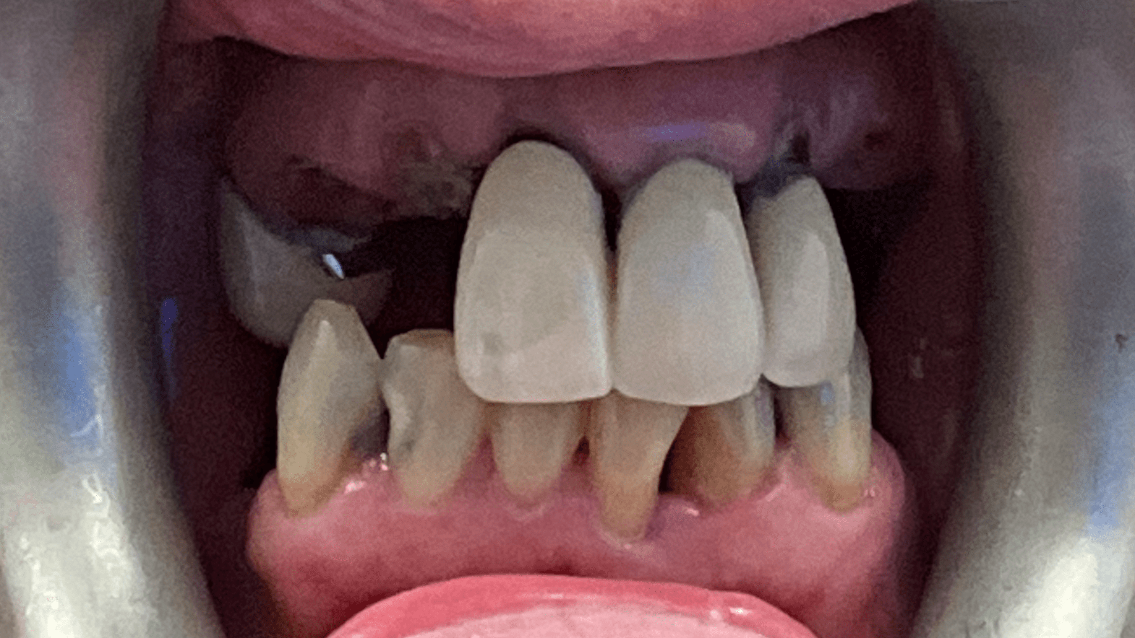 Patient before full arch restoration