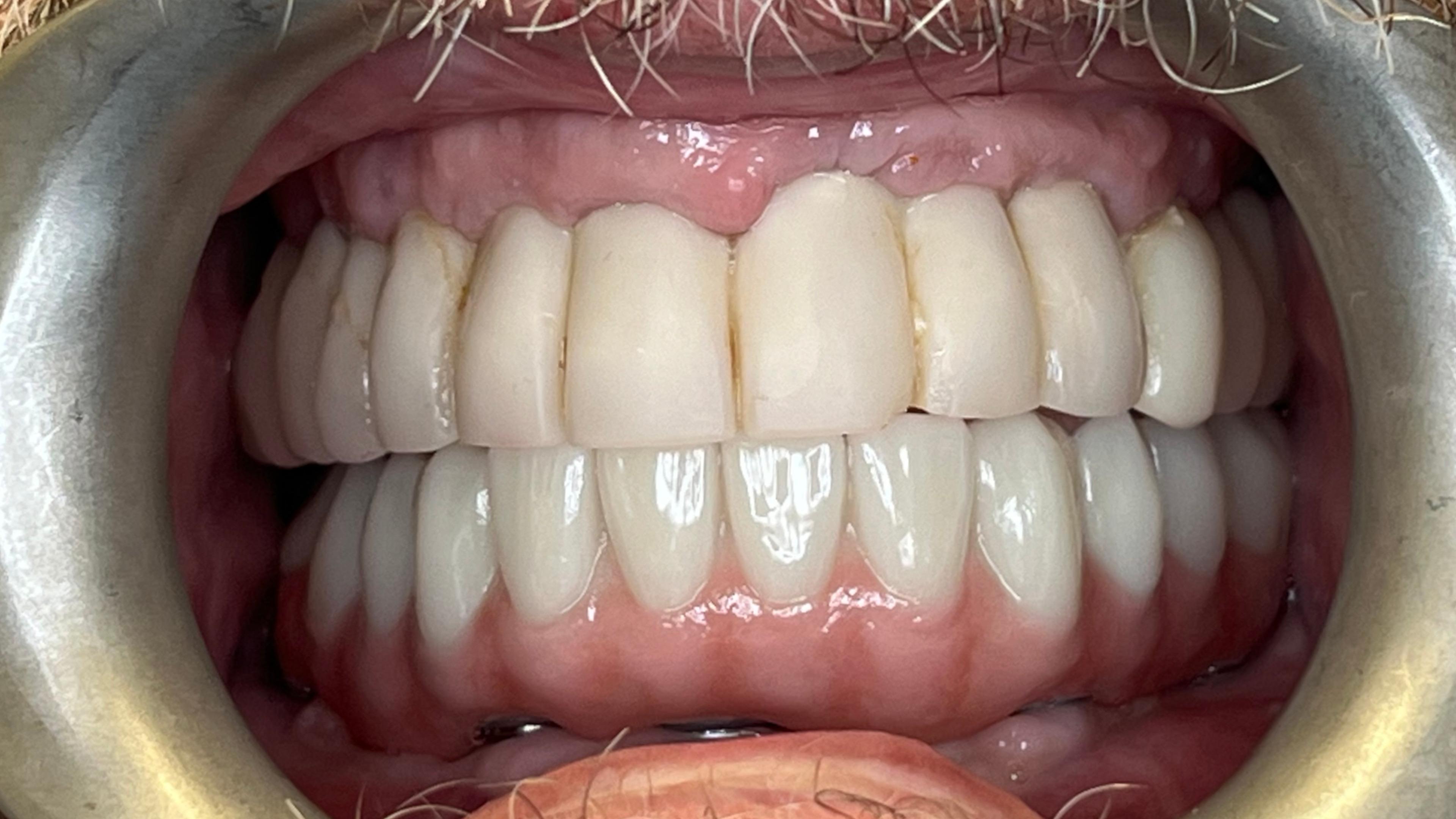 Patient after multiple implants procedure