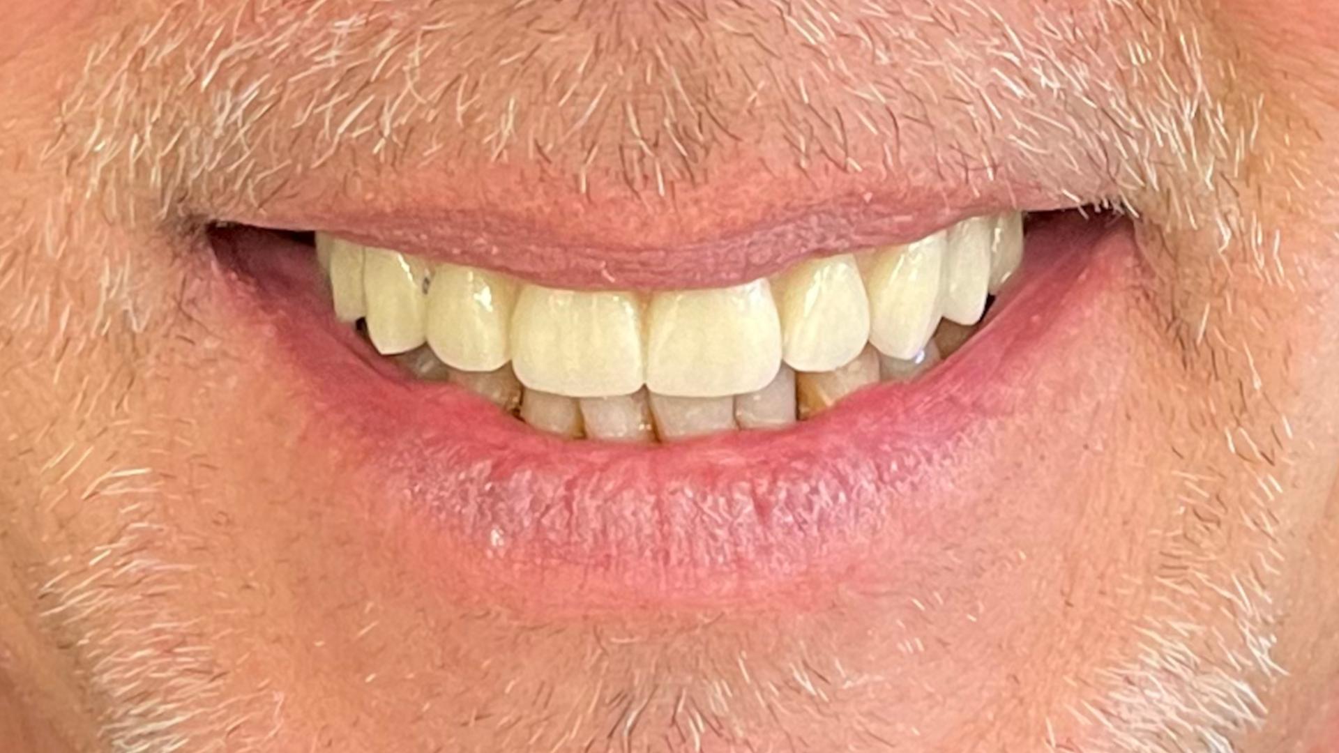 Patient after dental transformation showing beautiful smile