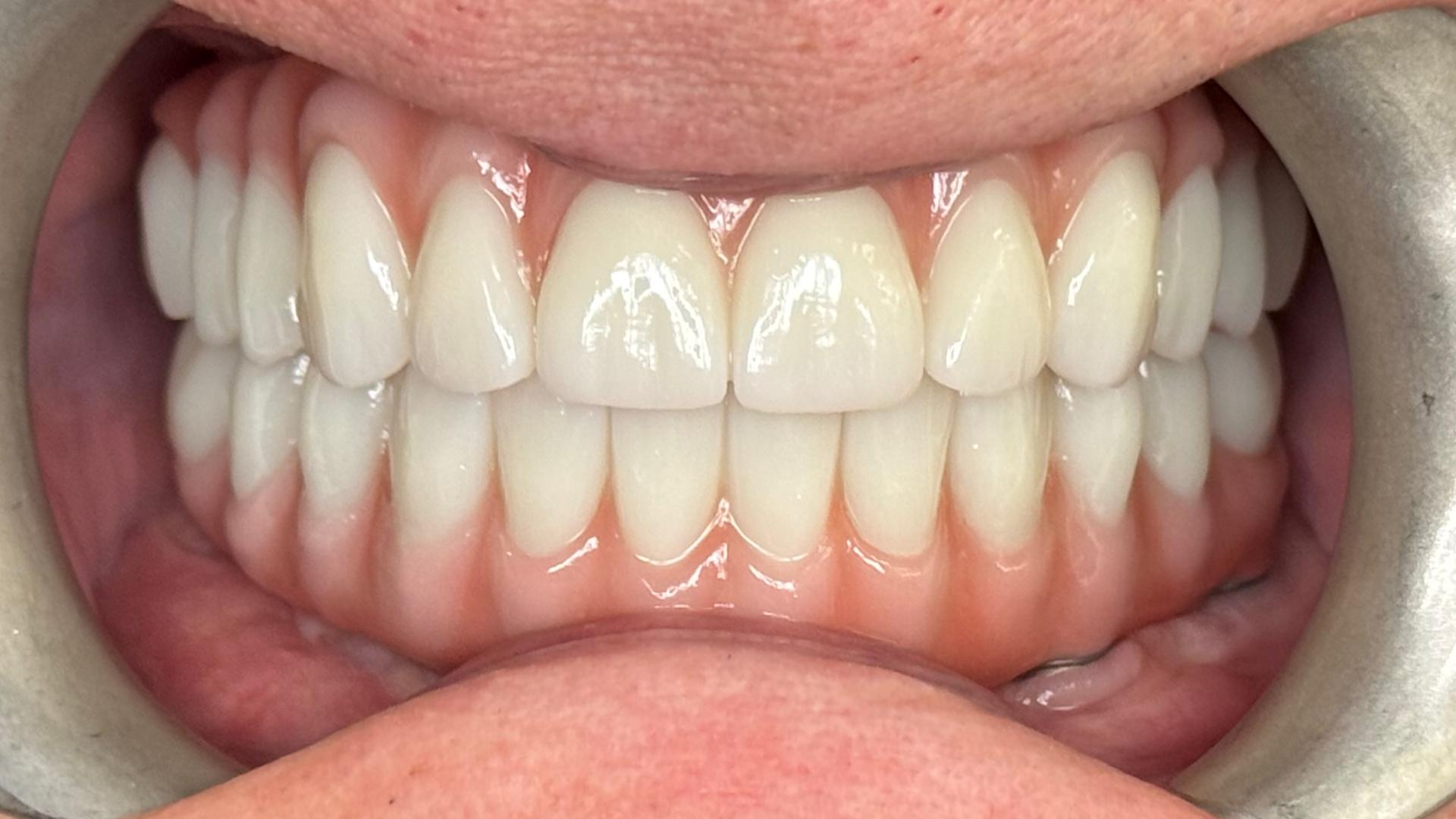 Patient after dental implants with confident smile