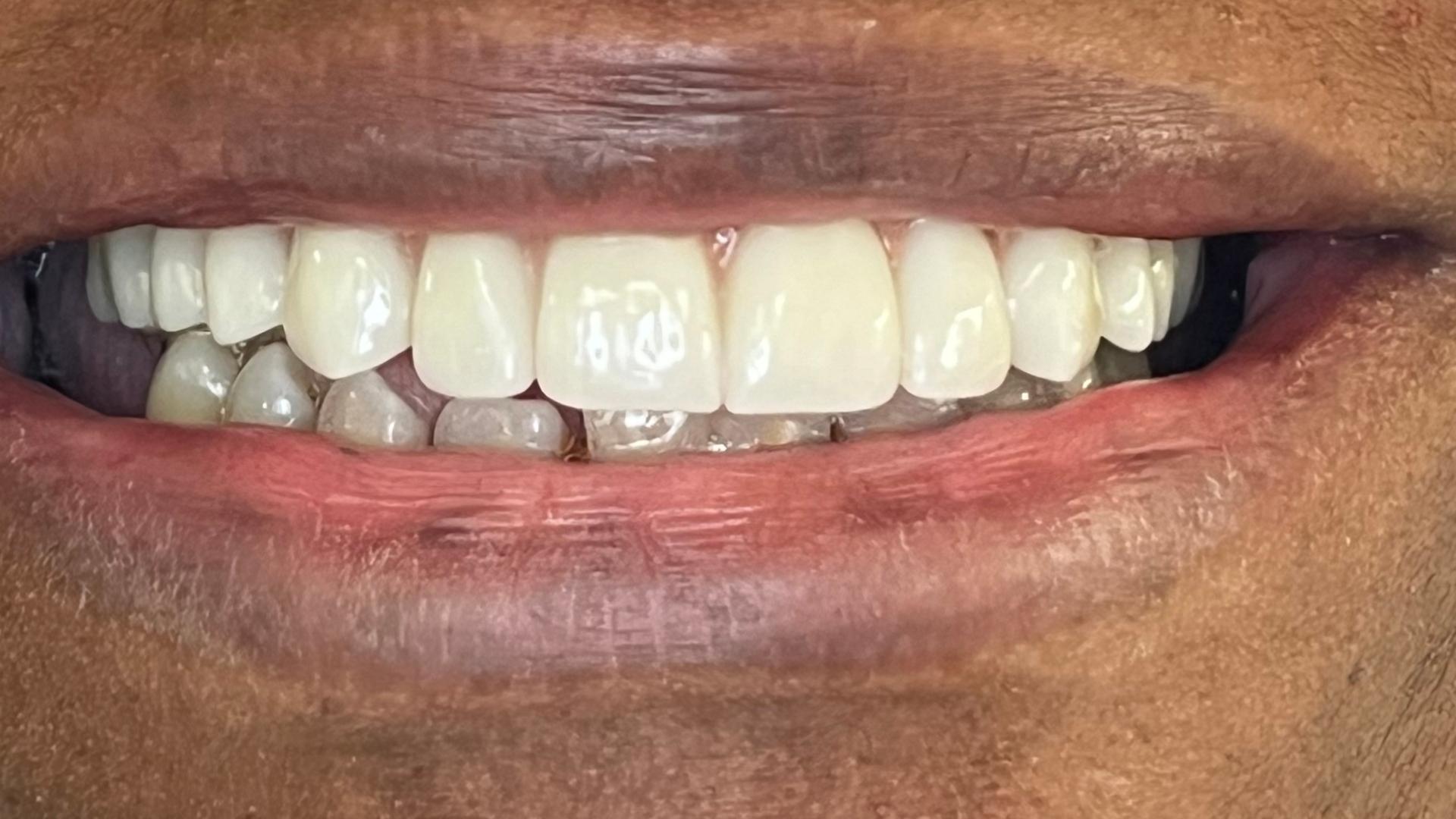 Patient after implant supported dentures treatment