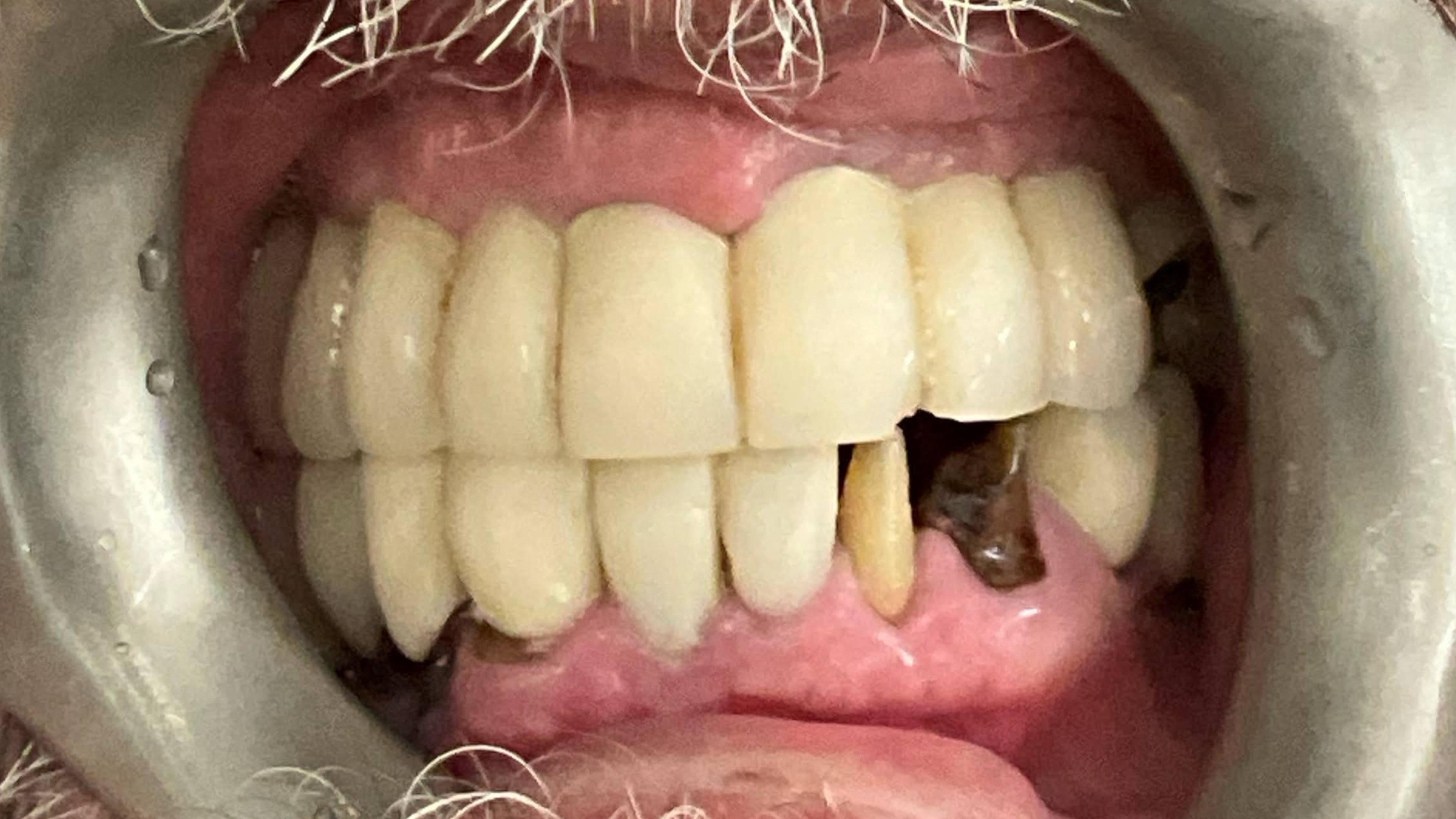 Patient before multiple implants