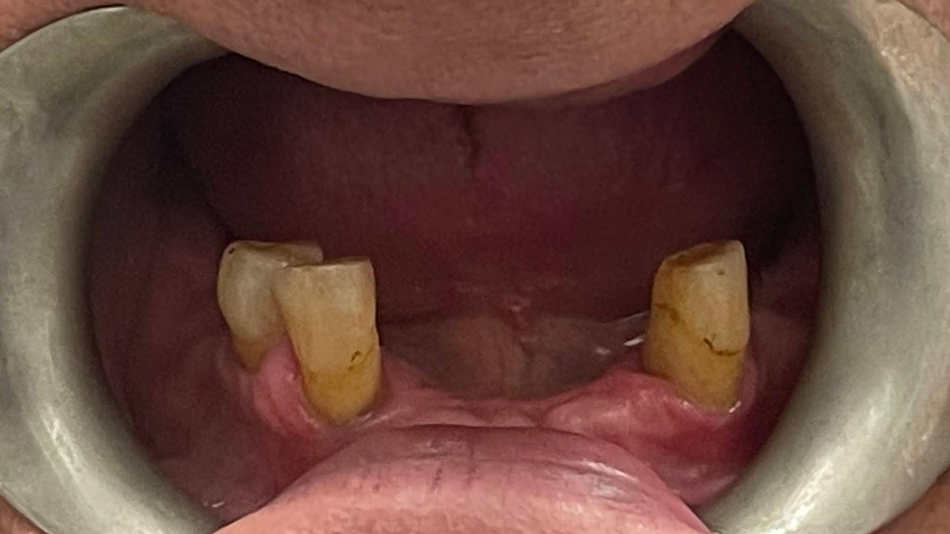 Patient before dental implants