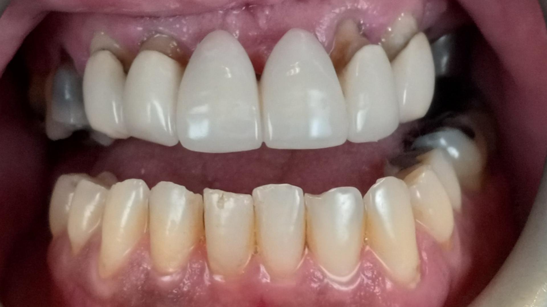 Patient before single tooth implant