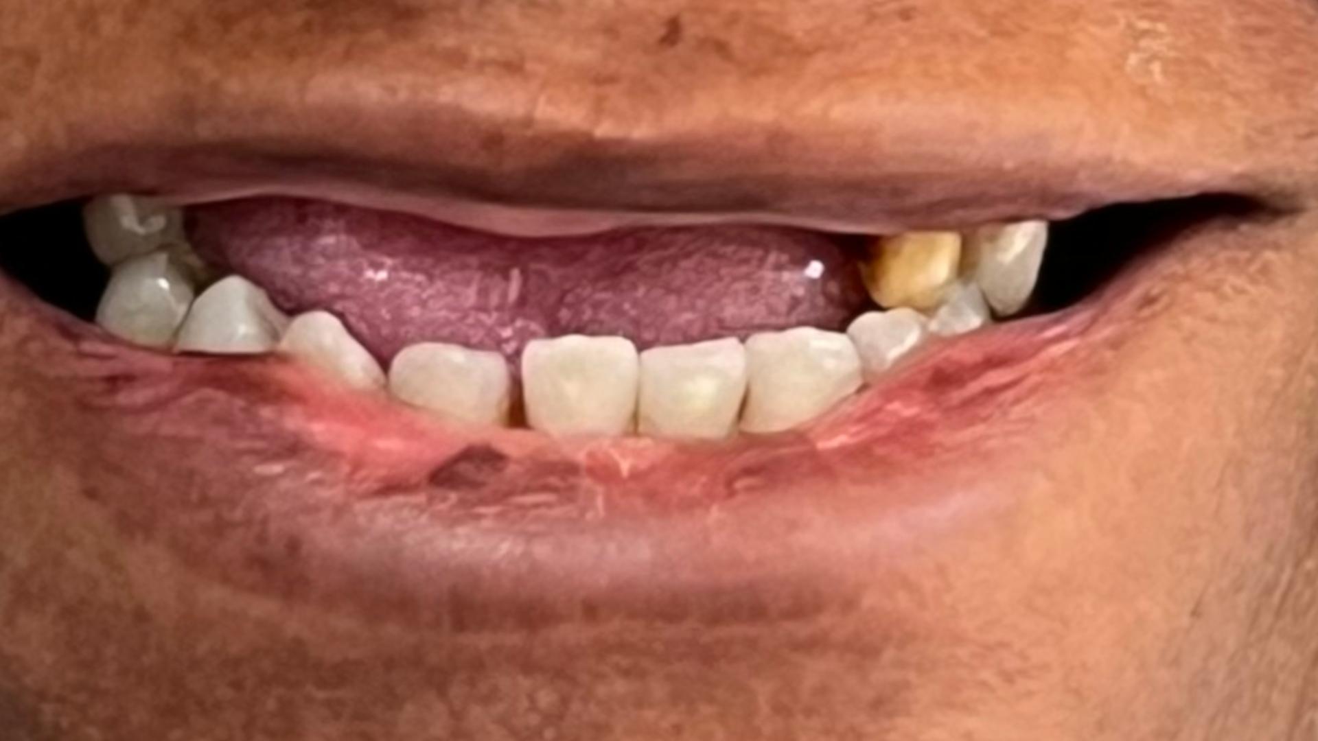 Patient before implant supported dentures