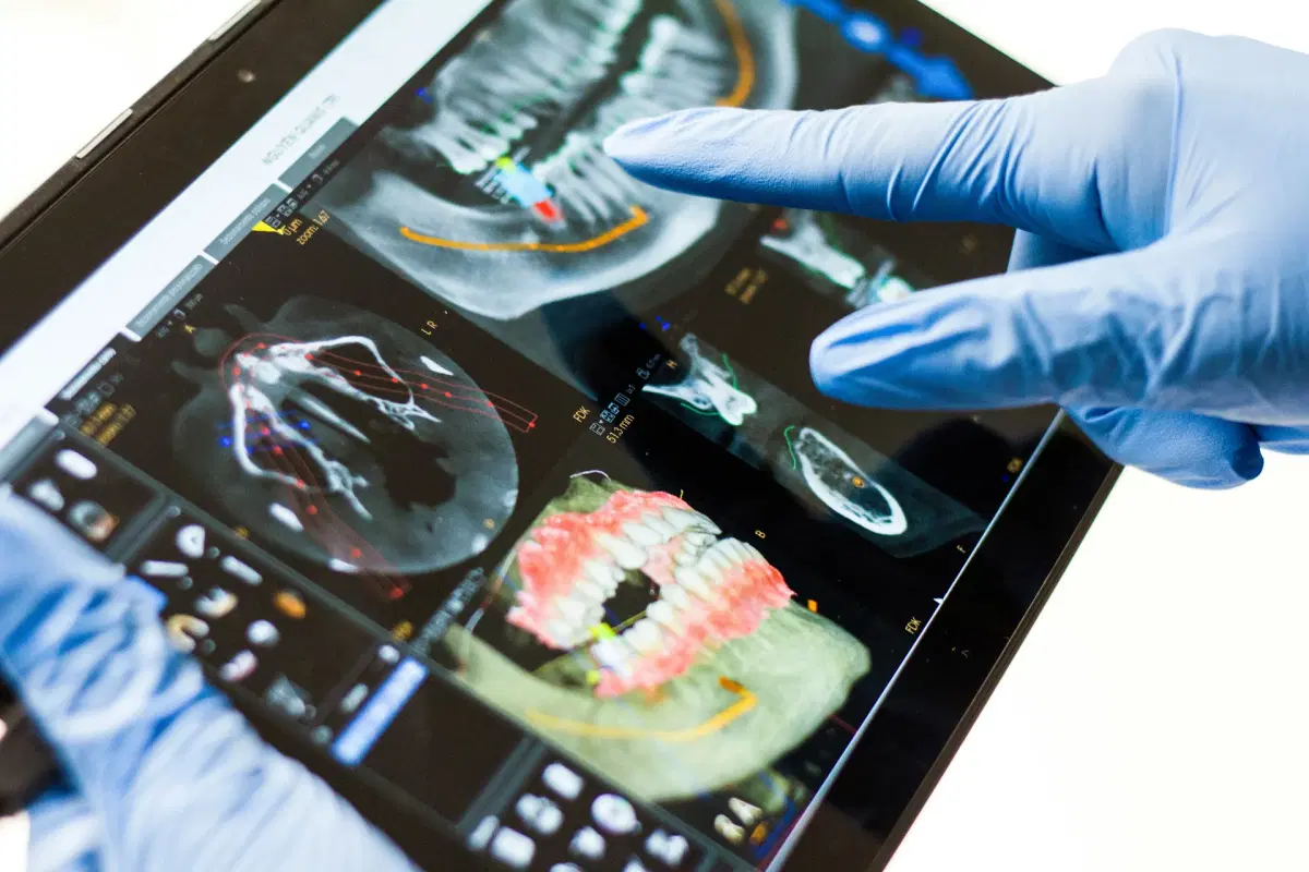 Dentist reviewing a 3D CBCT scan for precise implant planning