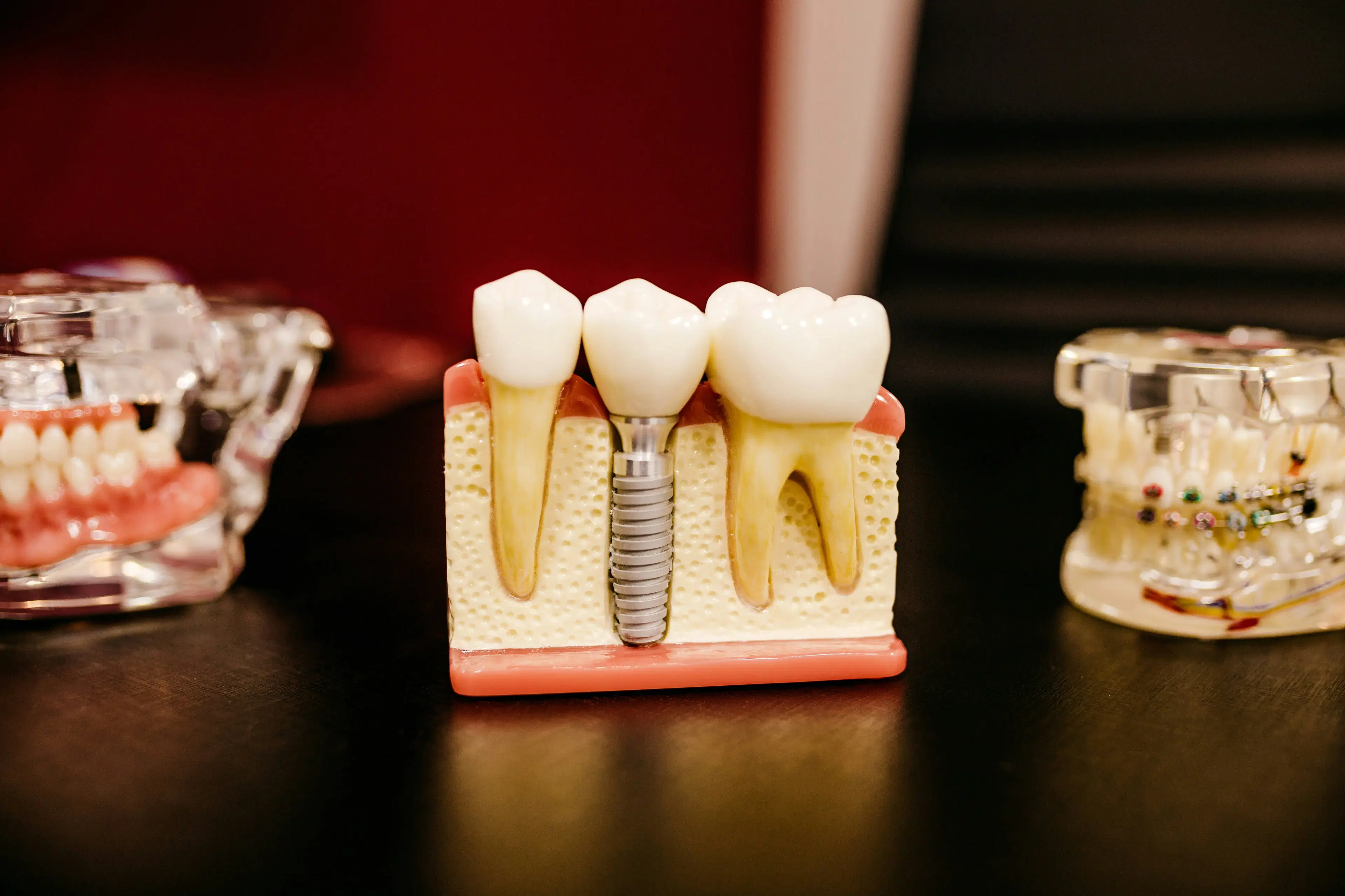 Natural-looking single tooth dental implant transformation
