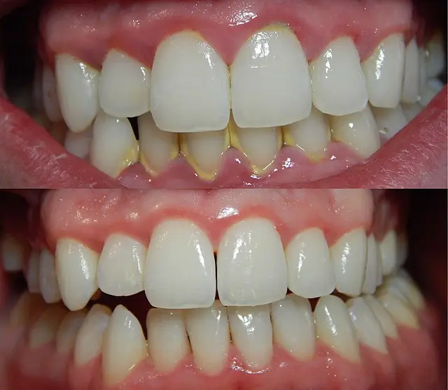 Comparison of healthy gums versus gum disease showing inflamed, bleeding gums with plaque buildup along the gumline compared to healthy pink gums after treatment